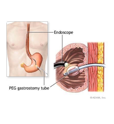 Gastroclinica - Exame - Gastrostomia Endoscópica Percutânea (GEP)