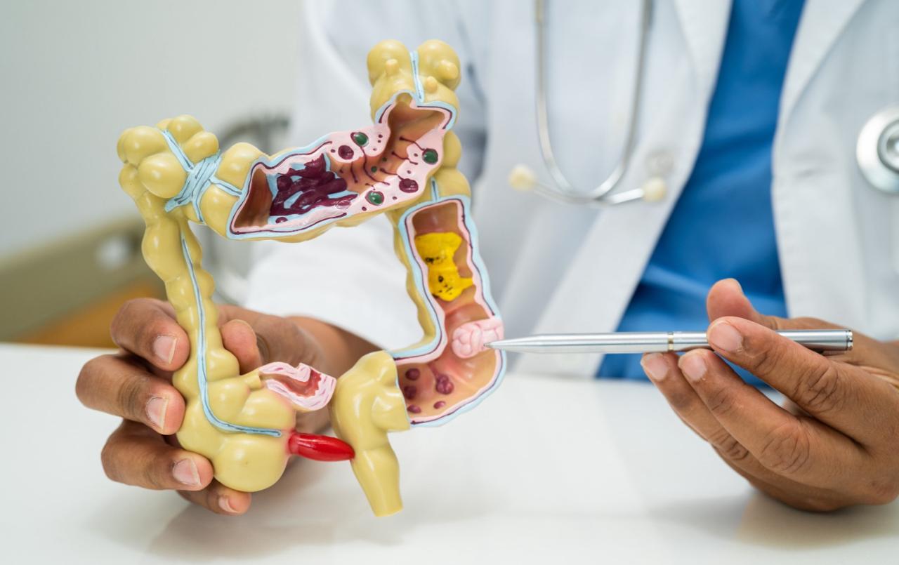 Câncer colorretal exige vigilância e prevenção: especialistas de Foz reforçam alerta nacional